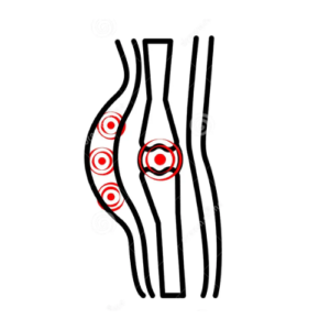Soft tissue injuries